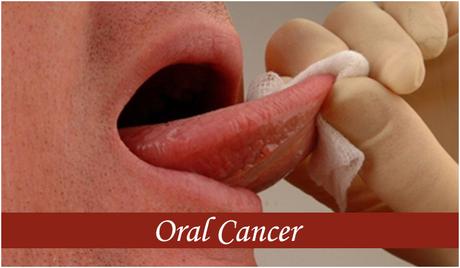 How to Treat Oral Cancer with Home Remedies ?