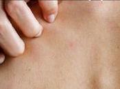 Treat Hidradenitis Suppurativa with Ayurveda