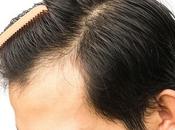 Amazing Outlook with Best Hair Transplant