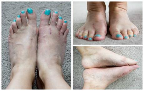 Free to Do as I Please – 3 Month Bunion Surgery Update