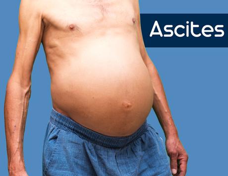 How to Treat Ascites with Natural Remedies ?