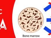 What Causes, Symptoms Treatment Severe Aplastic Anemia