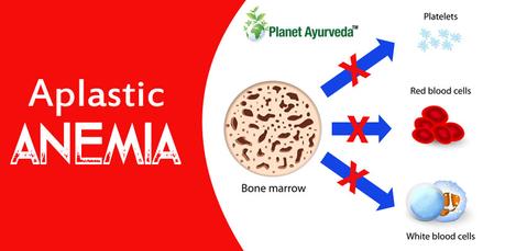 What are the Causes, Symptoms & Treatment of Severe Aplastic Anemia ?