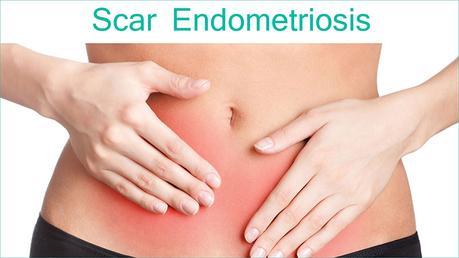 How to Treat Scar Endometriosis with Herbal Remedies ?