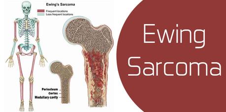 How to Treat Ewing Sarcoma in Ayurveda ?