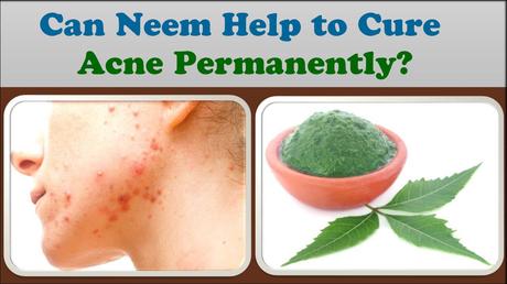 Can Neem help to cure acne permanently?