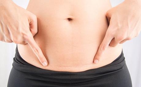 How to Get a Flat Stomach After a C-section (Home Remedies)