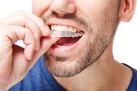 7 Facts That Will Help You Consider Invisalign