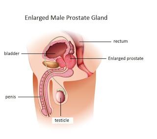 Common Prostate Diseases, dr deepak garg, dr deepak garg urologist