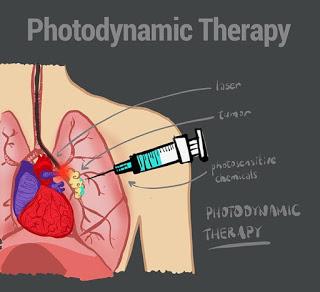 Photodynamic Therapy,Treating Cancer
