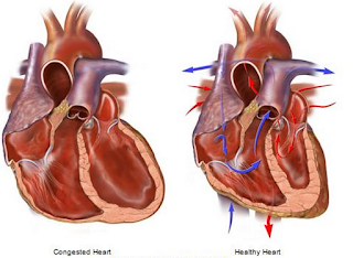 Congestive Heart Failure, Cardiologists in Navi Mumbai, Congestive Heart Failure Causes
