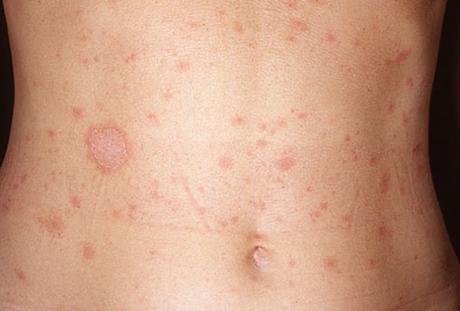 What is Pityriasis? Know more about it's treatment
