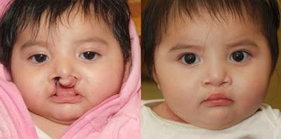 benefits of cleft lip surgery, Cleft lip surgery, Cleft palate surgery, Dr Abhinav Likhyani, 