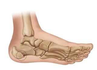 Heel Spur, Heel Spur Treatment, Orthopedists in indore