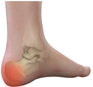 Pain In Heel, Heel Spur, 