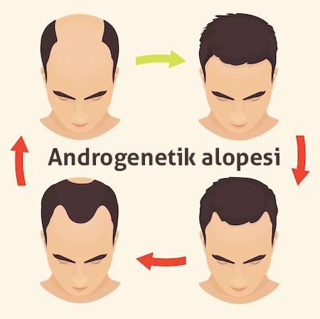 alopecia-stages