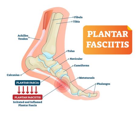 Best Running Shoes For Plantar Fasciitis