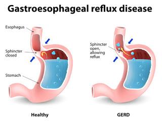 Gastroesophageal Reflux Disease, GERD, gerd cure,  