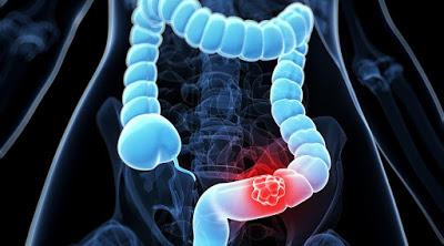 early symptoms of colon cancer, causes of colon cancer, dr sharad sharma, 