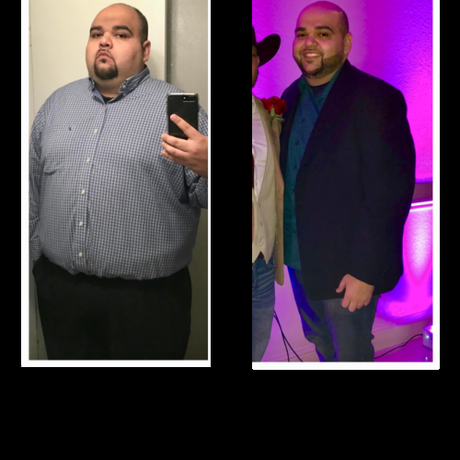 Jose’s Gastric Sleeve: Life Changing