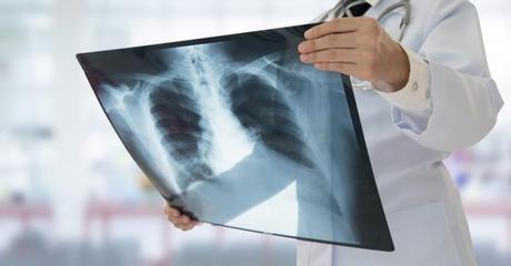 Do X-rays and CT scans increase the risk of cancer?