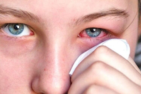 Pink Eye Causes and Effective Treatment Options