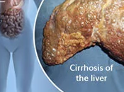 What Best Diet People With Liver Cirrhosis?