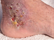 Treat Sores Ayurveda?