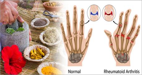 How Ayurveda Deals With Rheumatoid Arthritis (Ra)
