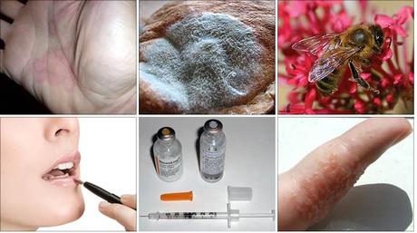 Ayurvedic Treatment of allergy