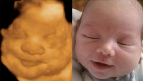 Baby image with 3D ultrasound and after delivery