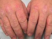 Reactive Arthritis Treated Naturally?