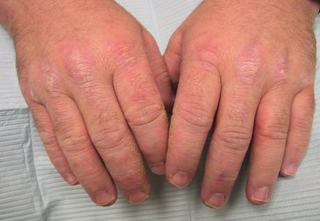 HOW REACTIVE ARTHRITIS CAN BE TREATED NATURALLY