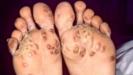 HOW REACTIVE ARTHRITIS CAN BE TREATED NATURALLY? symptoms of Reactive Arthritis