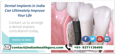 Dental Implants in India Can Ultimately Improve Your Life!!