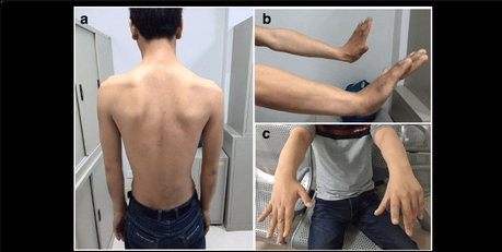 How to manage limb girdle muscular dystrophy type 2a through Ayurveda?