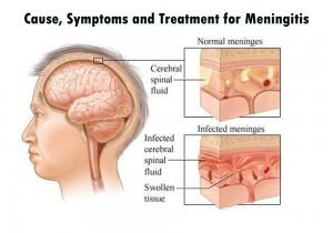 How Meningitis can be treated naturally How Meningitis can be treated naturally