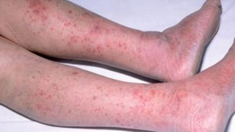 How Meningitis can be treated naturally How Meningitis can be treated naturally