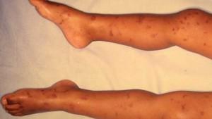 How Meningitis can be treated naturally How Meningitis can be treated naturally