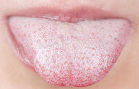 How to treat oral thrush naturally? How to treat oral thrush naturally?
