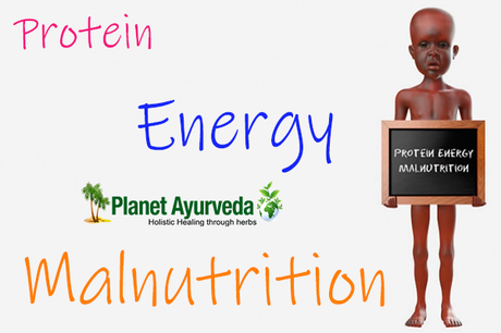 Protein Energy Malnutrition and Its Ayurvedic Management Protein Energy Malnutrition and Its Ayurvedic Management