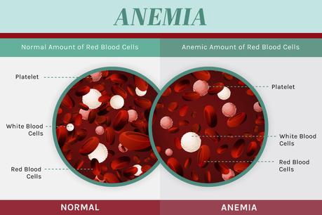 Anemia – An Ayurvedic perspective, herbal remedies and more Anemia – An Ayurvedic perspective, herbal remedies and more