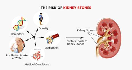 the-risk-of-kidney-stones-anatomy