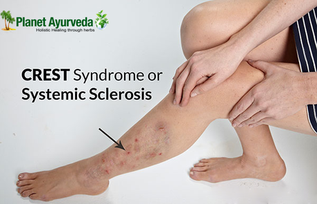 Systemic Scleroderma – A Rare Auto-Immune Disease! Systemic Scleroderma - A Rare Auto-Immune Disease!