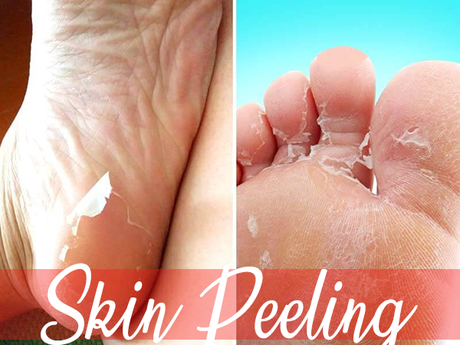 What Can Be the Causes of Skin Peeling on  the Hands