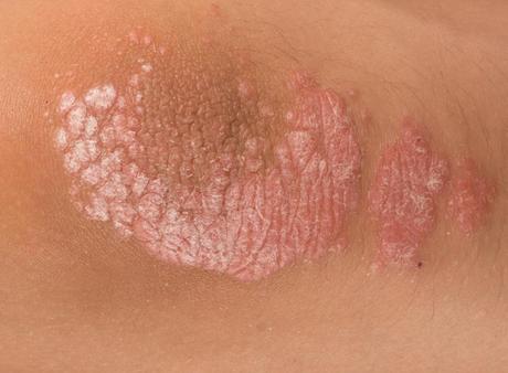 Natural Treatment for Psoriasis