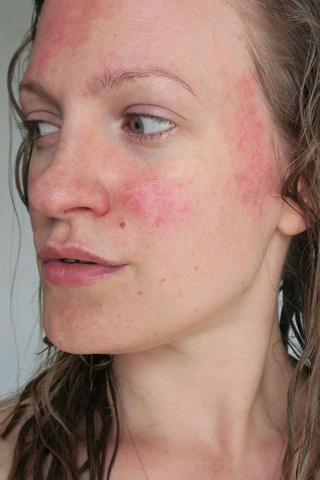 All you need to know about red spots or redness on the skin