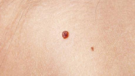skin tag picture