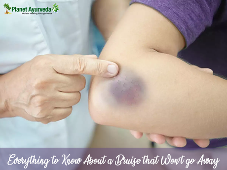 Everything to Know About a Bruise that Won't Go Away