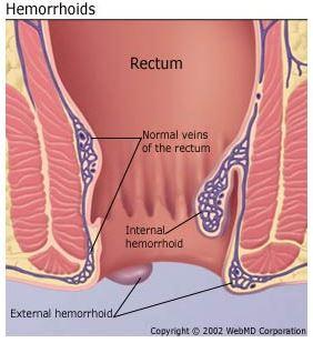 Hemorrhoids